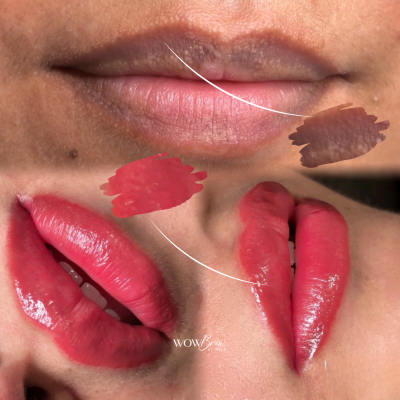 lip neutralization waterloo lip neutralization in kitchener